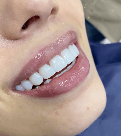 Natural smile transformation